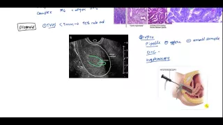 Endometrial Cancer and Hyperplasia for USMLE