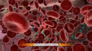 Behind the Mystery, Polycythemia Vera