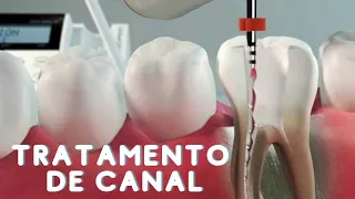 What is a Root Canal ?