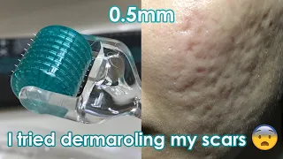 I tried dermarolling my ACNE SCARS! | Demo + Review