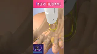 Fingers Shockwave Treatment #shorts