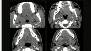 КТ диагностика рака шеи, часть 3, ротоглотка