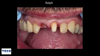 Clinical Tip: Single Edentulous Space