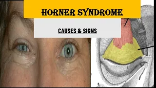 UNDERSTANDING HORNER SYNDROME | CAUSES & SIGNS