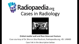 Orbital medial wall and floor blow-out fracture (Radiopaedia.org) Cases in Radiology