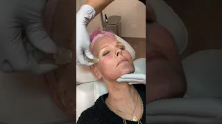 Custom microinjection facial