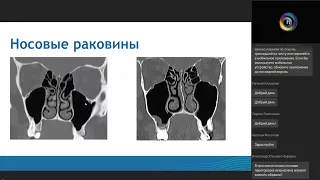 Компьютерная томография придаточных пазух носа перед FESS