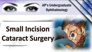 Small Incision Cataract Surgery | SICS | AP'S Undergraduate Ophthalmology