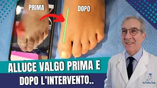 Alluce valgo prima e dopo l'intervento  | TECNICA del Dott. Andrea Scala