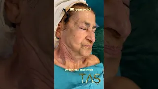 80 years-old doctor has a scarless facelift under local anesthesia #profdrsuleymantas