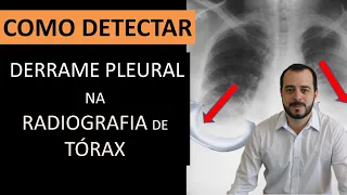 DESCOMPLICANDO: DERRAME PLEURAL NA RADIOGRAFIA DE TÓRAX. FICOU FÁCIL?