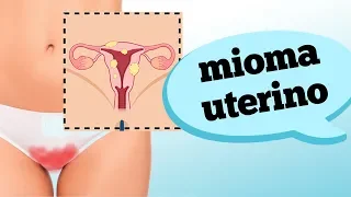 MIOMA NO ÚTERO: QUANDO SE PREOCUPAR?