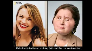 21-year-old woman becomes youngest in US to receive face transplant