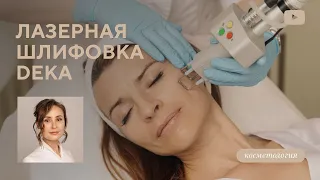 Лазерная шлифовка лица на аппарате DEKA SmartXide.