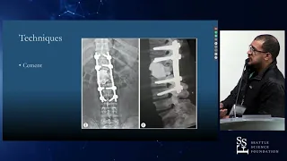 The Role of Anterior Column Reconstruction in Spine Surgery - Amir Abdul Jabbar, MD