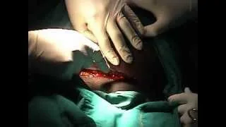 Caesarean Section: Making the abdominal incision