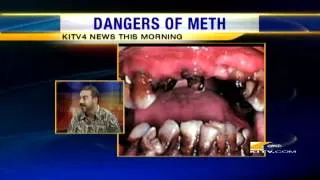 Shocking Effects Of Meth Mouth