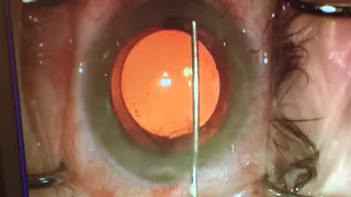 Dropless Cataract Surgery