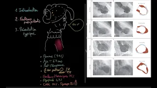 Cardiomyopathie de Takotsubo - Docteur Synapse