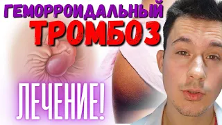 Геморрой/ Геморроидальный тромбоз. Лечение