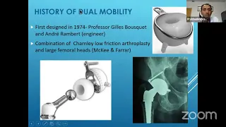 Dual Mobility Components in Total Hip Replacement