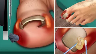 ASMR Ingrown toenail ! Treatment corner of the toenail - Beautiful pedicure for girls