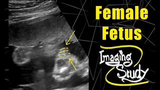 Female Fetus - Its a Girl || Ultrasound || Case 119