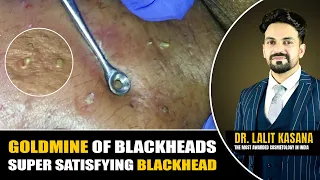 GOLDMINE OF BLACKHEADS II SUPER SATISFYING BLACKHEAD REMOVAL BY DR.LALIT KASANA