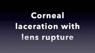 CORNEAL LACERATION - SUTURING TECHNIQUE