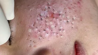 Extreme Blackhead Removal at LNG Skin Care #037
