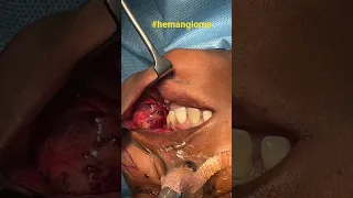 Surgical Miracle - A Huge Blood Filled Tumor Hemangioma is Removed without any blood loss!