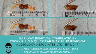 EAR WAX REMOVAL COMPILATION - STICKY PLUG & QUICK EAR WAX PLUG REMOVAL - EP247