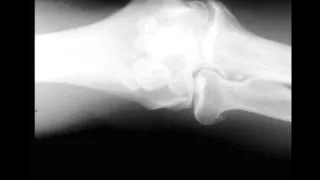 Loose Bodeis in Elbow Joint on X ray