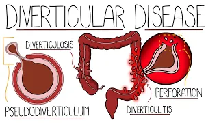 Understanding Diverticular Disease (Diverticulosis vs Diverticulitis)