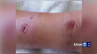 Hawaii mail carrier recalls nasty dog bite incident