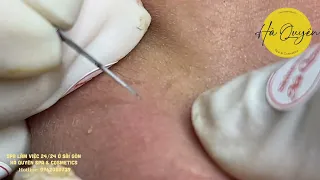 |545| Blackheads & Acne treatment 11/06/2023