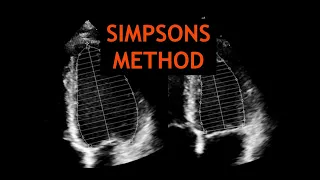 Simpsons Method: Echocardiography