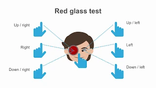 Extraocular Movements: Analyzing CN 3, 4, and 6 Abnormalities