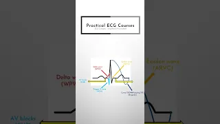 Visual Mnemonic for causes of Syncope - What to look for on an ECG?