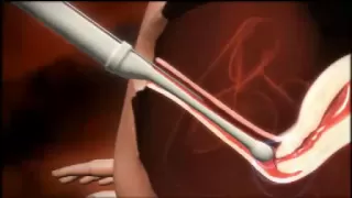 3D animation of how IVF works