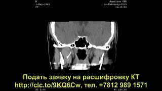 Расшифровка КТ пазух носа - как расшифровать диск КТ