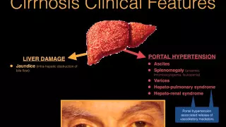 Chronic liver disease & cirrhosis - Dr. MDM