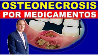 ⚠️ OSTEONECROSIS OF JAW AND MAXILLA IN ANTIRRESORTIVE DRUGS, BIPHOSPHONATES AND ANTIANGIOGENICS