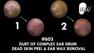 603 - Duet of Complex Eardrum Dead Skin Peel & Ear Wax Removal