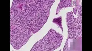 Histopathology Ureter--Transitional cell carcinoma