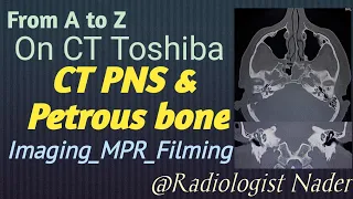 مقطعية علي عظام الاذن|الجيوب الانفية|المخ|توشيبا|CT|Petrous bone|PNS|Brain|Toshiba