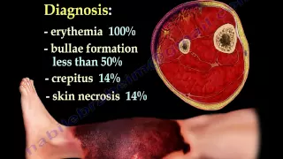 Necrotizing Fasciitis .Everything You Need To Know - Dr. Nabil Ebraheim