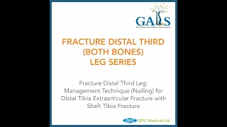 Management Technique (Nailing) for Distal Tibia Extraarticular Fracture with Shaft Tibia Fracture