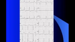 Managing STEMI Mimics in the Prehospital Environment (part 3/3)