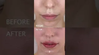 👄 FEMALE RUSSIAN LIP AUGMENTATION WITH KEYHOLE POUT USING JUVEDERM VOLLURE | DR JASON EMER TIKTOK